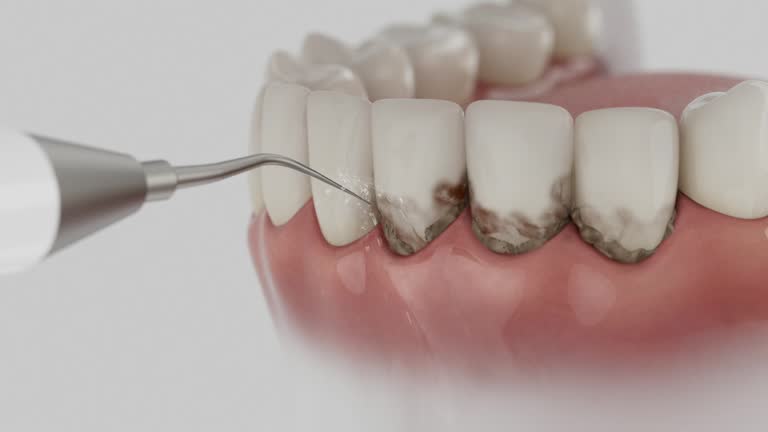 Trusted Wisdom Tooth Removal service in Burwell, NE - Dentist Open Now